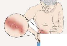 日常生活：纏腰龍到底是什么東西流傳腰上長一圈就壽命已盡